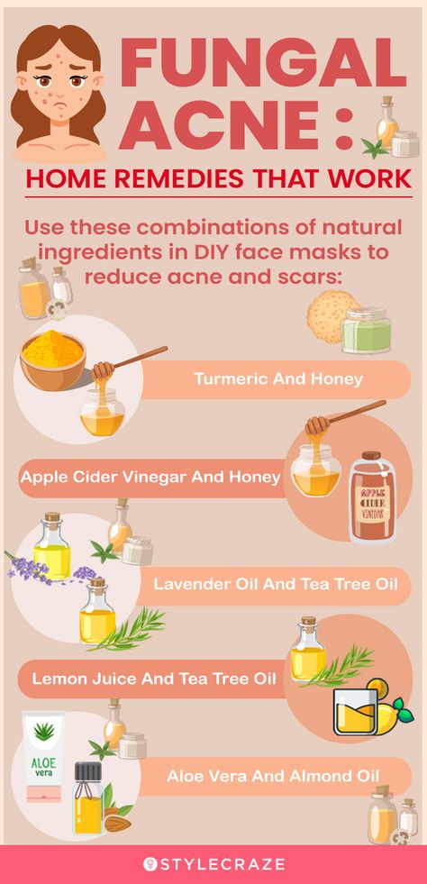 Back Acne Remedies, Cystic Acne Remedies, Fungal Acne, Blind Pimple, Acne Vulgaris, Diy Acne, Natural Acne Remedies, Natural Acne, Home Remedies For Acne