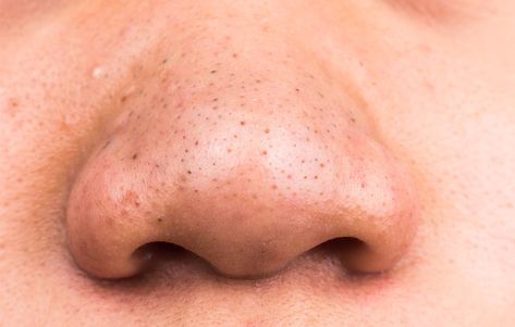 Ask Dr. Pimple Popper: 'How Do I Get Rid Of My Disgusting Blackheads?' How To Treat Blackheads, Remove Blackheads From Nose, Blackhead Remedies, Blackheads On Nose, Types Of Acne, How To Get Rid Of Pimples, Get Rid Of Blackheads, Beauty Tips For Face, Mascara Facial