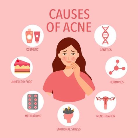 "Unmasking Acne: Understanding Its Origins" Delve into the root causes of acne and discover ways to unveil clearer, healthier skin. #AcneAwareness #ClearSkinJourney #acne #acneprone #acnetreatment #acnestudios #acneskin #soulbeautycosmetology #acnecauses Cause Of Acne, Causes Of Acne, Acne Causes, Healthier Skin, Unhealthy Food, Acne Skin, Cosmetology, Skin Health, Clear Skin