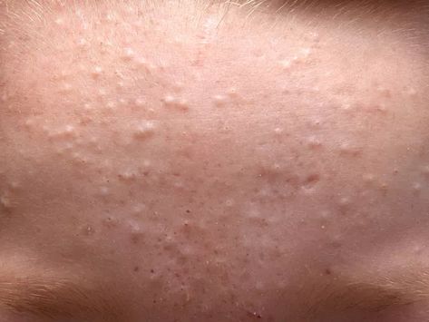 Identifying and Treating Closed Comedones Remove Skin Tags Naturally, Types Of Acne, Bumpy Skin, Cold Sores Remedies, Get Rid Of Blackheads, Body Hair Removal, Natural Cough Remedies, Acne Remedies, Low Carb Recipes Dessert