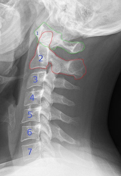 Punkty Spustowe, Cervical Pain, Cervical Spondylosis, Neck Pain Relief, Leg Pain, Neck Pain, Migraine, Massage Therapy, Chronic Pain