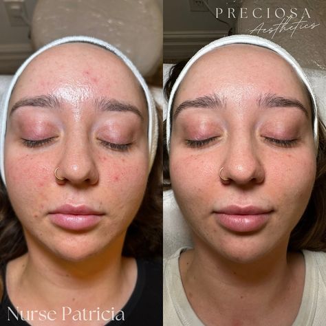 💉MICRONEEDLING💉 These amazing results came after just one session of microneedling! Redness is gone, even skin tone and texture, less acne, pores have shrunk, less oil production, and even tightened her skin! Ready to put your best face forward? Come see us! Book through the link in our bio or send us a DM! 📩 #microneedling #skincare #glassskin #dp4microneedling #skin #beauty #aesthetics #cosmetics #botox #nucieva #fillers #toronto #mississauga #portcredit #oakville Aesthetic Treatments, Port Credit, Oil Production, Face Forward, Best Face, Skin Care Treatments, Glass Skin, Best Face Products, Even Skin Tone