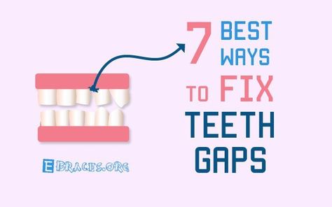 gap in teeth How To Get Rid Of A Gap In Your Teeth, Small Gap In Teeth, Gap In Teeth, Gaps In Teeth, Fix Teeth, How To Help Nausea, Gap Teeth, Nice Teeth, How To Get Better