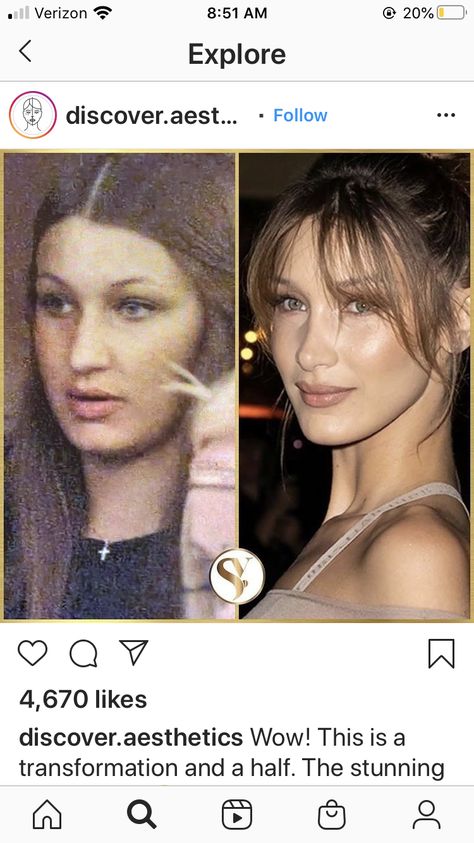 Distortion Photography, Rhinoplasty Nose Jobs, Instagram Vs Real Life, Before And After Pics, Facial Fillers, Facial Aesthetics, Celebrity Plastic Surgery, Beauty Habits, The Kardashians