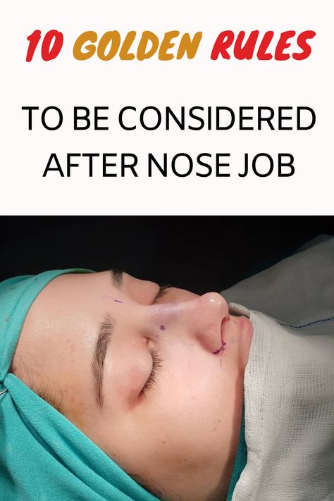 Rhinoplasty (nose job) provides a beautiful nose that is compatible with the face and aesthetically pleasing. In rhinoplasty, it is very important for the patient to fully trust her doctor and decide together on the procedure to be performed. In rhinoplasty, the basic principle is to obtain the desired shape by preserving the basic functions of the nose. If the patient needs it, many other procedures can be performed during rhinoplasty surgery. Rhinoplasty Swelling Progression, Rhinoplasty Recovery Tips, Nose Inspiration Rhinoplasty, Ideal Nose Rhinoplasty, Broken Nose Surgery, Best Nose Jobs, Bulbous Nose Rhinoplasty Before After, Rhinoplasty Before After, Rhinoplasty Recovery Timeline