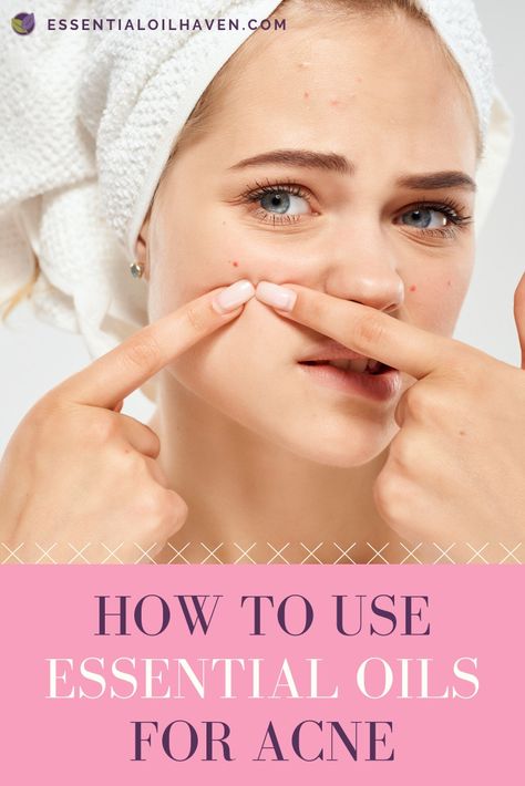 Top 5 Best Essential Oils for Acne. #essentialoilhaven #essentialoils #acne #essentialoilsforacne #skincare Essential Oils For Acne, Oils For Acne, Essential Oils For Colds, Essential Oils For Headaches, How To Get Rid Of Pimples, Essential Oils For Skin, Essential Oil Diffuser Blends, Skin Blemishes, Oil Diffuser Blends