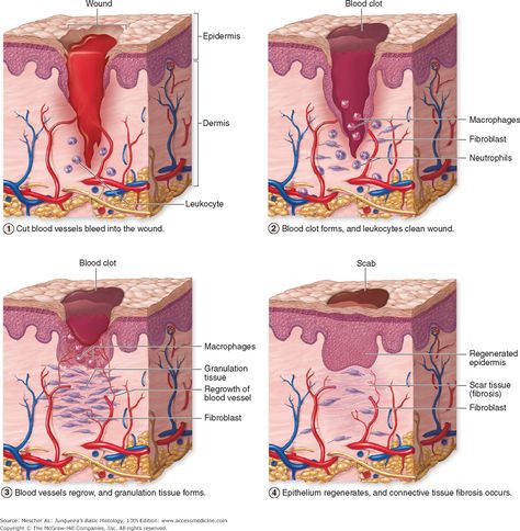 Stages in Wound Healing Plastic Surgery Recovery, Acne Body Wash, Nursing Cheat, Baby Acne, Integumentary System, Acne Scarring, Treat Acne, Human Anatomy And Physiology, Acne Problem