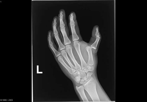 Dislocation 1st MCP joint Pediatric Radiology, Fracture Healing, Radiology Technician, Dentistry Student, Nuclear Medicine, Surgery Recovery, Stick On Nails, Radiology, X Ray