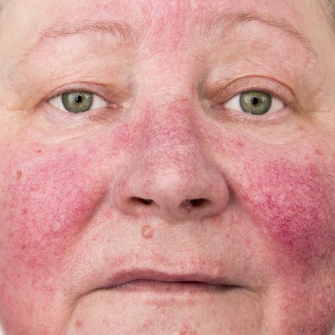 Do you suffer with #rosacea? Apply a gentle, broad-spectrum sunscreen with an SPF of 30 or higher every day. A fragrance-free sunscreen that contains zinc oxide, titanium dioxide, or both is least likely to irritate your sensitive skin. Forehead Blackheads, Small Bumps On Forehead, Cheek Acne, Forehead Bumps, Natural Remedies For Pimples, Pimples On Forehead, Chest Acne, Forehead Acne, Pimples Remedies