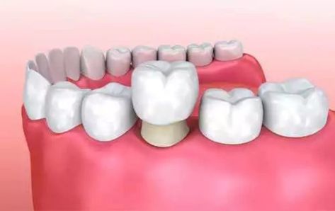 Dental Crown Dental Crown Procedure, Clove Dental, Dental Bridge Cost, Temporary Crown, Porcelain Crowns, Tooth Crown, Dental Implant Surgery, Kedokteran Gigi, Dental Implants Cost