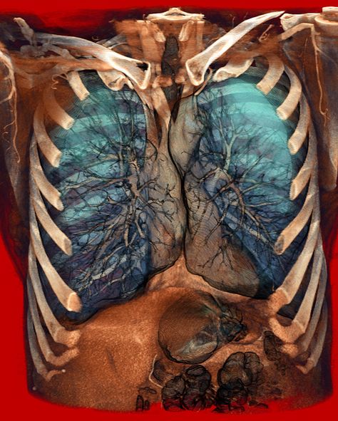 Volume Rendering of a thoracic CT scan, COPD. Lung Anatomy, Respiratory Care, Chronic Obstructive Pulmonary Disease, Respiratory Therapy, Ct Scan, Pulmonary Disease, Medical Illustration, Anatomy And Physiology, Medical History