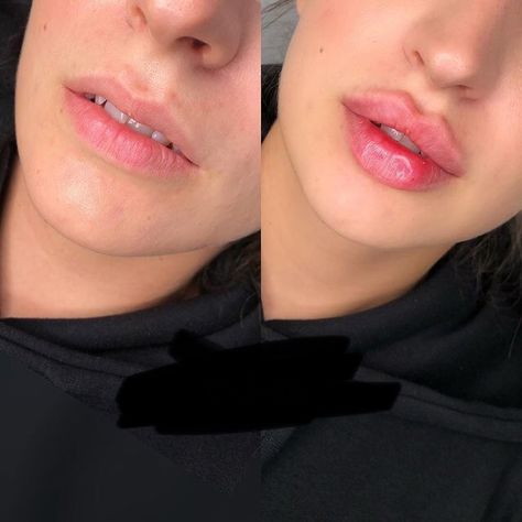 Lip Fillers Juvederm, Dermal Fillers Lips, Juvederm Lips, Lips Fillers, Lips Shape, Lips Inspiration, Face Fillers, Botox Lips, Glossy Eyes