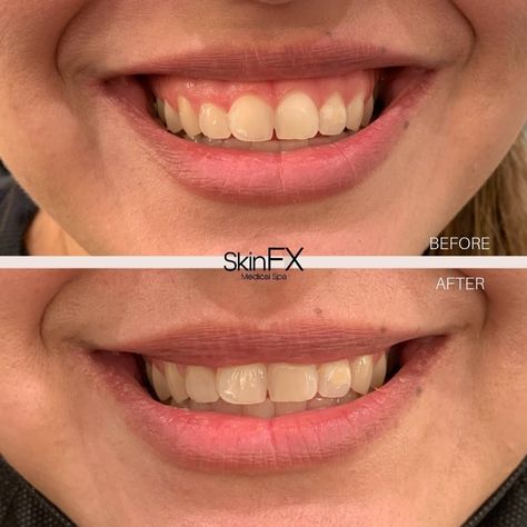 Aesthetic nurse, gummy smile correction with botox, symmetrical smile Lip Flip Botox Before And After, Gummy Smile Correction, Collagen Injections, Botox Before And After, Aesthetic Nurse, Gummy Smile, Lip Filler, Smile Lines, Lip Injections