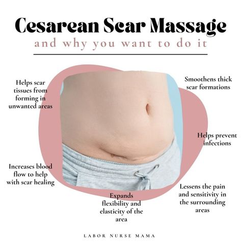 Did you have a belly birth? ⁠ ⁠ 🤰🏼Hi mama, I’m Trish, also known as @labor.nurse.mama. Be sure to follow for pregnancy, birth, and postpartum tips from a mom of 7 and 16 yr labor nurse ❤️⁠ ⁠ You should definitely add scar massage into your daily routine! ⁠(try @sacralgardenskincare oil)⁠ ⁠ Cesarean scar massage only takes about 5 minutes of your time and you can be done anywhere. However, you may want to use an oil to prevent tugging on the skin. Even coconut oil will work if you have it. ⁠ ⁠... Scar Tissue Massage, Cesarean Recovery, Scar Massage, Cesarean Delivery, C Section Scars, Cesarean Section, Labor Nurse, Post Baby, Newborn Hat