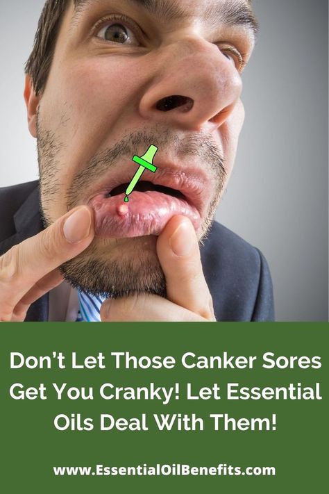 Don’t Let Those Canker Sores Get You Cranky! Let Essential Oils Deal With Them! Canker Sore Remedies Essential Oils, Essential Oil For Canker Sore In Mouth, Essential Oils For Mouth Ulcers, Essential Oils Canker Sore, Tongue Sores, Strong Teeth, Essential Oils For Pain, Canker Sore, Essential Oils Guide