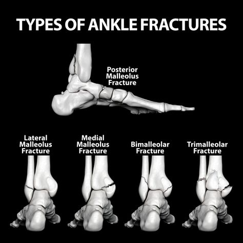 Ankle Fracture Surgery | Florida Orthopaedic Institute Physiotherapy Notes, Avulsion Fracture, Types Of Fractures, Orthopedic Nursing, Ankle Fracture, Radiology Student, Radiology Imaging, Ankle Surgery, Medical School Life