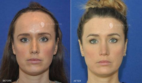 Forehead Reduction Surgery, Plastic Aesthetic, Forehead Reduction, Hair Transplant Women, Reduction Surgery, Nikah Dress, Doctor On Call, Hair Line, Brow Lift