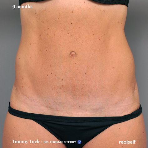 "The tummy tuck helped me feel more confident in my body, but there were a lot of things I learned along the way." Skin Removal Surgery Before And After, Tummy Tucks Post Op, Tummy Tucks Recovery List, Mini Tummy Tucks Before And After, Tummy Tucks Recovery Tips, Tummy Tucks Before And After, Mommy Makeover Surgery Recovery, Body Lift Surgery, Surgery Prep