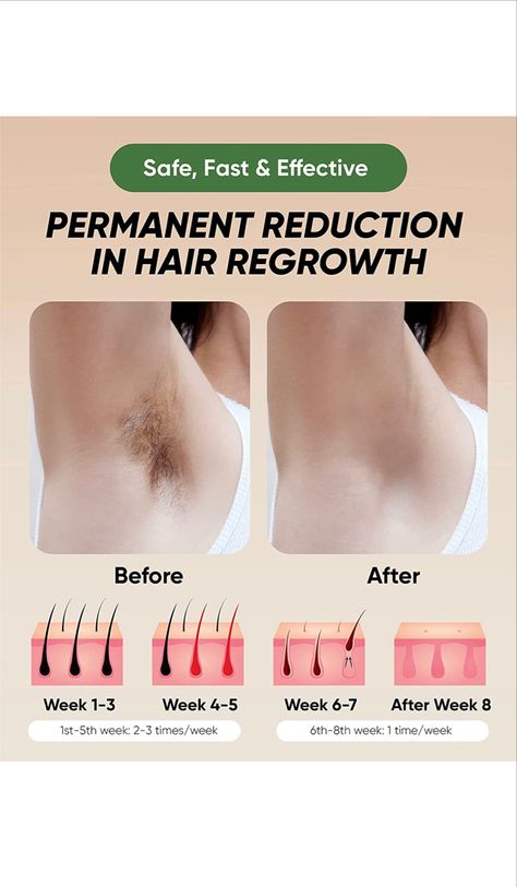 70% off! | Laser Hair Removal | Only $59.85! Hair Regrowth Shampoo, Permanent Hair Removal, Underarm Hair Removal, Hair Growth Secrets, Laser Hair Removal Machine, Hair Regrowth Treatments, Hair Removal Machine, Hair Removal Device, Ipl Hair Removal