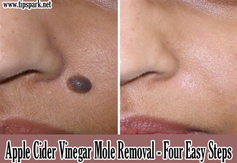 ... Home Remedies For Skin, Skin Moles, Mole Removal, Beauty Remedies, Diy Health, Beauty Recipe, Natural Home Remedies, Homemade Beauty Products, Health And Beauty Tips