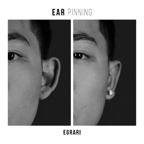 OTOPLASTY // Ear Pinning⁠ - Overly large ears, protruding ears, or misshapen ears can be reshaped or "pinned", laying nicely and naturally against your head so you feel completely comfortable wearing your hair up, in a ponytail, or a short cut.⁠ Protruding Ears Hairstyle, Big Ears, A Ponytail, Surgery Center, Ear Pins, Short Cut, Health Center, Return To Work, Short Cuts