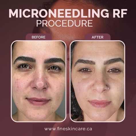 ✨ Microneedling RF: Before & After ✨ BEFORE: Fine lines, acne scars, spots, uneven skin tone and texture. AFTER: Smoother, firmer, glowing youthful skin✨ Book your session today! 💫 #microneedling #microneedlingrf #skinclinic #torontoskinclinic #antiaging #esthetician #beautyclinic Before And After Microneedling, Microneedling Before And After, After Microneedling, Beauty Clinic, Beauty Goals, Skin Clinic, Youthful Skin, Uneven Skin, Uneven Skin Tone