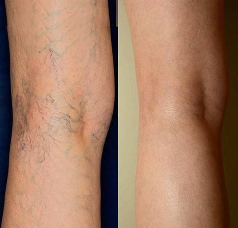 Vein Health, Varicose Vein Removal, Healthy Legs, Varicose Vein Remedy, Visible Veins, Venous Insufficiency, Green Veins, Improve Blood Circulation, Health Skin Care