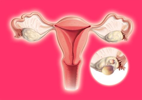 Polysistic Ovarian Syndrome, Female Reproductive System, Blood Sugar Diet, Polycystic Ovarian Syndrome, Polycystic Ovaries, Sciatic Nerve Pain, Sciatic Nerve, Nerve Pain, Women's Health