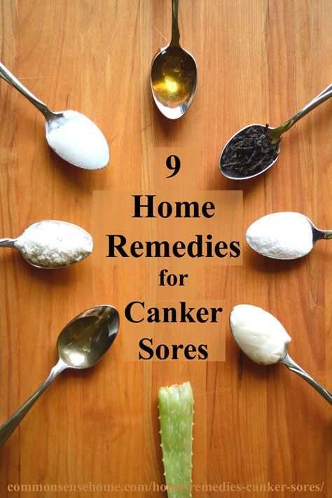 9 Home remedies for canker sores that are fast acting and inexpensive to stop the pain and heal the hurt, plus tips for avoiding canker sores and the difference between canker sores and cold sores. Cold Sore Remedy Fast, Canker Sore Remedy, Cold Sores, Canker Sore, Cold Sores Remedies, Cold Home Remedies, Cold Sore, Homemade Remedies, Natural Health Remedies