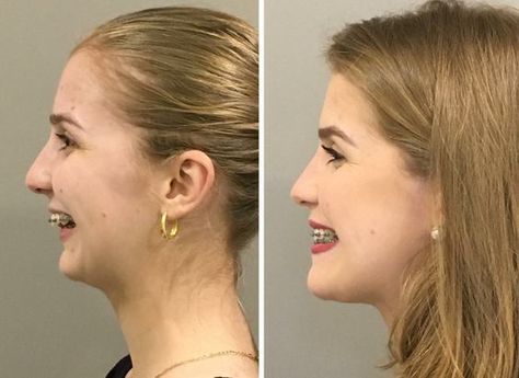 #plasticsurgery #plasticsurgerygonewrong #beforeafter #celebritiesbeforeafter #hollywoodstars #bignosesurgery #surgery #facesurgery #vlinesurgery #koreanplasticsurgery #kpopplasticsurgery #nosejob #jawreductionsurgery #eyesurgery #cheekfillers #rhinoplasty #facelift #plasticsurgeryfails #expensiveplasticsurgery Perfect Teeth Braces, Jaw Reduction Surgery, Double Jaw Surgery, Plastic Surgery Fail, Face Fillers, Face Surgery, Plastic Surgery Gone Wrong, Facial Anatomy, Jaw Surgery