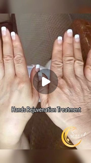 Sareh Adeli on Instagram‎: "PRP hand rejuvenation is suitable for individuals looking to improve the appearance of aging hands without undergoing invasive surgery. It’s also a good option for those who prefer natural treatments over synthetic fillers.

Consulting with a trained dermatologist or cosmetic professional is essential to determine if PRP is the right choice for you.
پروسیجر جوان سازی دست ها با استفاده از درمان پی آر پی 🤩🤩💫🌟
For more information please feel free to contact us 👉🏻👉🏻 @sareh_medical_aesthetic 
@sareh_medical_aesthetic 
@sareh_medical_aesthetic 
#botox
#fillers
#PRP_hair_loss
#facialPRP
#vampire_facial"‎ Hand Rejuvenation, Prp Hair, Vampire Facial, Botox Fillers, Medical Aesthetic, Natural Treatments, Surgery, Facial, Medical