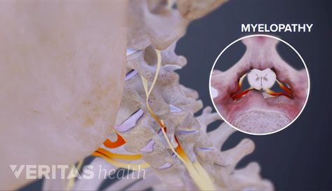 Cervical Myelopathy, Spine Health, Spinal Cord, Whiplash, Health