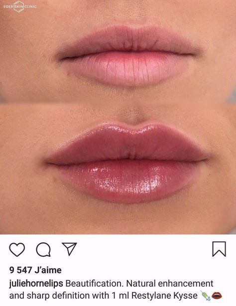 Good Lip Filler Pictures, Lip Blush And Filler, Lip Injections Inspiration, Sydney Sweeney Lips, Lip Injection Inspiration, Lip Filler 2ml, Perfect Lips Injections, .5 Lip Filler, Lip Filler On Small Lips