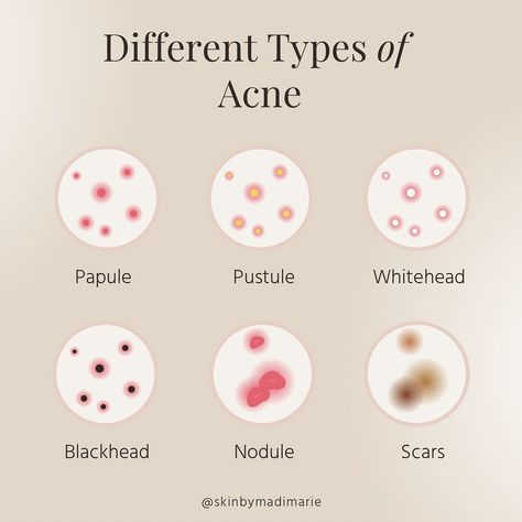 Acne Spots Meaning, Pimple Solution, Red Moles, Different Types Of Acne, Vegan Probiotics, Clean Blackheads, Acne Help, Types Of Acne, Clear Complexion