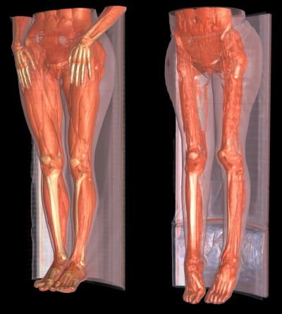 This image represents 3-D reconstruction of a healthy individual (left) and someone affected by a form of limb-girdle muscular dystrophy (right). The dramatic loss of muscle is easily seen. Myotonic Dystrophy, Medical Terminology Study, Muscle Diseases, Duchenne Muscular Dystrophy, Spinal Muscular Atrophy, Muscular Dystrophy, Muscle Protein, Skeletal Muscle, Beauty Supplements