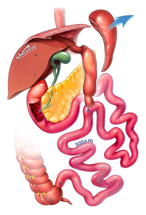 SADI-S surgery in Sydney is a newer duodenal switch surgery for bariatric weight loss. Lose weight while retaining more nutrients in the food you eat. Duodenal Switch, Stomach Sleeve, Consulting Room, Bariatric Surgeon, Sleeve Gastrectomy, Private Hospitals, Cylinder Shape, Surgery, Sydney