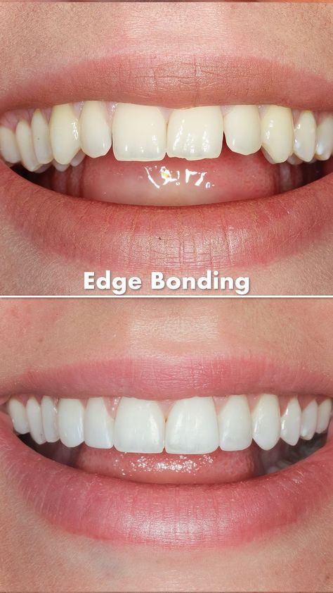 This is a beautiful example of how small changes using edge bonding can completely transform your smile. Dr Fearghal applies composite bonding directly to the teeth to even out the worn edges and fill any spaces. The result is a brilliant, stunning, confident smile. . 😁 Transform Your Smile 💰 From €250 Per Tooth 💶 Edge bonding €150 Per Tooth 👨🏻‍⚕️ Free Consultation 🚧 No Drilling 🦷 No Change to Tooth Structure 🚫 Pain-Free 💶 €50 Refundable Deposit 💳 Payment Plans 🗓 Lasts 5-7 Years Short Teeth Smile, Teeth Cosmetic Dentistry, Small Teeth Smile, Composite Bonding Teeth, Dream Teeth, Perfect Teeth Smile, Teeth Makeover, Cosmetic Bonding, Teeth Bonding