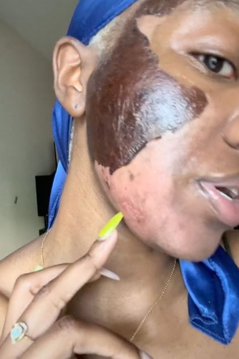 This TikTok user had chemical peel burns after having a deep peel done by an aesthetician which caused burns and post-inflammatory hyperpigmentation. Burn Care, Chemical Burn, Post Inflammatory Hyperpigmentation, Peeling Skin, Chemical Peel, Beauty Images, Gone Wrong, Beauty Inspiration, Skin