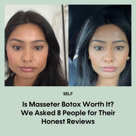 If you regularly wake up with a sore jaw, chances are you’ve come across masseter Botox as a possible remedy. Yep, even though botulinum toxin (the scientific name for Botox) is most known for its ability to temporarily smooth facial wrinkles, it’s got some research-backed medical benefits, too. But, like with anything, there are always risks. We asked eight people who got the injections if the results lived up to the hype—and justified the price. Tap the link in bio for their answers. Masseter Botox Before And After, Sore Jaw, Botox Before And After, Botulinum Toxin, Facial Wrinkles, The Hype, Wake Up, Wrinkles, Tap