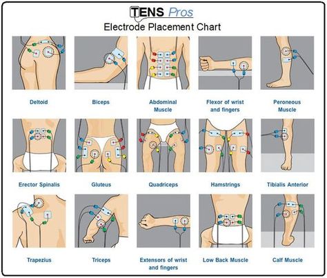 TENS unit electrode placement chart for different sports/life injuries. Repinned by SOS Inc. Resources pinterest.com/sostherapy/.: Tens Electrode Placement, Tens Unit Placement, Tens And Units, Tens Machine, Tens Unit, Ten Unit, Nerve Pain Relief, Sciatic Nerve, Different Sports