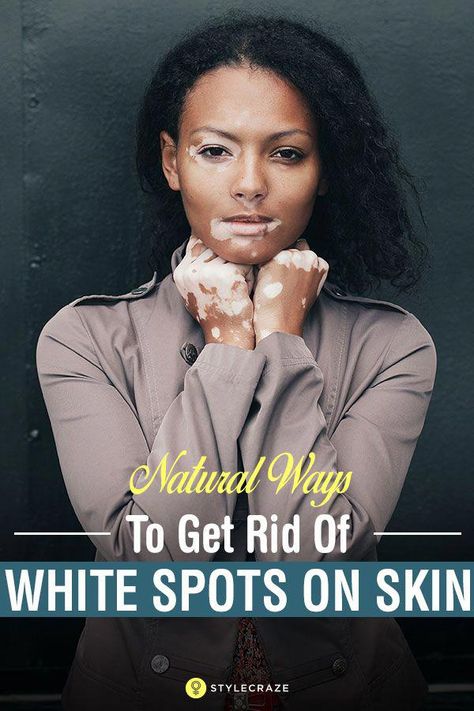 21 Natural Ways To Get Rid Of White Spots On Skin (Vitiligo) #NaturalRemediesForSickness White Spots On Skin, Spots On Skin, Remove Skin Tags Naturally, Weight Changes, Skin Spots, White Patches, Lose 40 Pounds, Medical Prescription, Skin Conditions