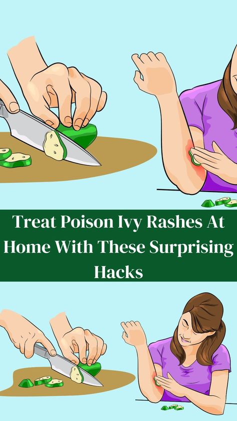 Treat Poison Ivy Rashes At Home With These Surprising Hacks How To Treat Poison Ivy Remedies, Poison Oak Remedies, Natural Remedies For Poison Ivy, How To Dry Up Poison Ivy Rash, Heat Rash Remedy, Poison Ivy Rash Pictures, Poison Oak Rash, Anti Itch Remedy, Poison Ivy On Face