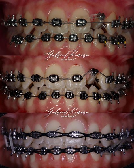 Red Braces Aesthetic, Braces Patterns, Braces Power Chain, Invisalign Hacks, Power Chain Braces, Dental Braces Colors, Braces Colors Combinations, Braces Before And After, Red Braces