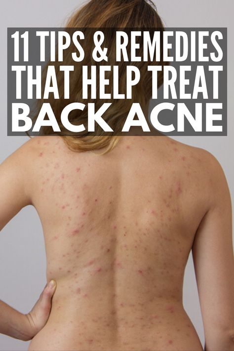 Back Acne Causes, Get Rid Of Back Acne, Rid Of Back Acne, Back Acne Remedies, Chest Acne, Scalp Problems, Prevent Pimples, Back Acne, Acne Overnight