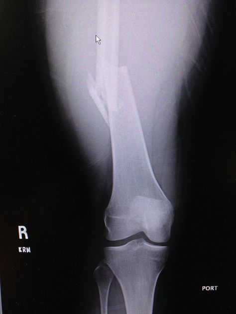 Same femur fracture. You can see it is comminuted (3 pieces) and without question this patient is bleeding into their thigh. Put on a traction splint ASAP. Femur Fracture, X Rays, Medical Education, Ballet Shoes, Put On, Medicine, Sport Shoes, Medical, Education