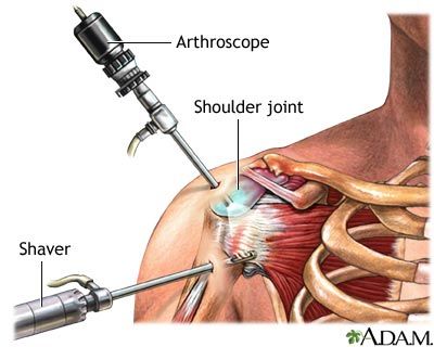 Arthroscopic Shoulder Surgery, Shoulder Surgery Recovery, Shoulder Anatomy, Rotator Cuff Exercises, Rotator Cuff Surgery, Shoulder Rehab, Shoulder Impingement, Rotator Cuff Tear, Rotator Cuff Injury