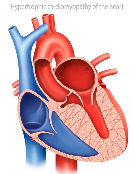 HYPERTROPHIC CARDIOMYOPATHY: Condition in which the muscle of the walls of heart chambers become stretched, thickened or stiff. Heart Chambers, Pleural Effusion, Body Bones, Medical Knowledge, Disease