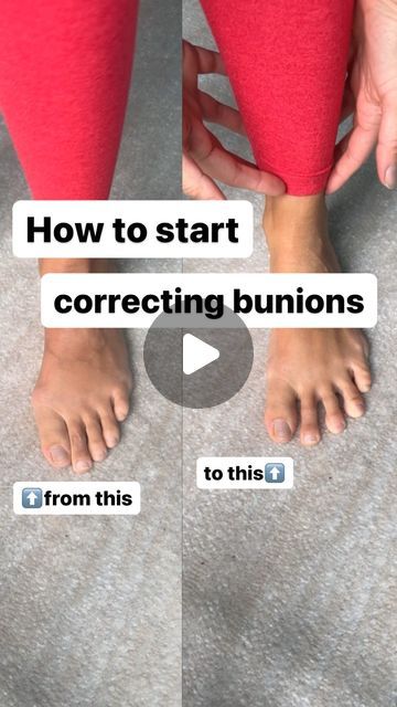 Heidi • Barefoot Functional Movement on Instagram: "Grab The Bunion Protocols with Beginners Foot Strength at www.thatbarefootcoach.com!  It would be impossible for me to cover all necessary nuances and exercises in 90 seconds. The purpose of this exercise and example is to demonstrate that bunions don’t occur in silo.  This is why Beginners Foot Strength is a necessary part of the process. You need to…  👣address your foot function as a whole 👣get out of the environment that contributed to the bunions (tapered toe shoes) 👣dedicate yourself to the process and journey, because there is no easy or overnight fix  For more in depth info check out my blogs on my website. . . . . #Foothealthawareness #barefootworkout #footpainrelief #barefooting #minimalistshoes #barefoottraining #strongfeet # Bunionette Taping, Seronegative Ra, Toe Exercises, Ankle Exercises, Toe Straightener, Functional Movement, Toe Spacers, Chin Exercises, Foot Exercises