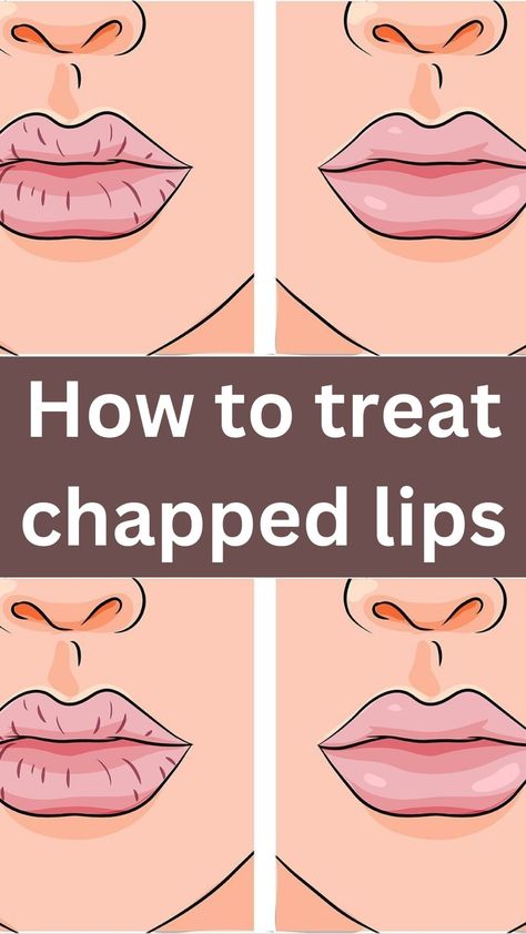 With Winter here, chapped lips are simply inevitable. The colder temperature and harsh winds create the perfect storm, no pun intended, for dried, chapped lips.  Chapped lips can be painful and irritating, creating splits and open cracks on the lip’s surface. And while many chap sticks claim to work, many times, they’re packed with unknown chemicals and ingredients, leaving lips more chapped and dehydrated than before. There are many ways to treat weathered lips with simple products found Severely Chapped Lips Remedy, Chap Lips Remedy, Chap Sticks, Chapped Lips Remedy, Abdominal Stretches, Beauty Hacks That Actually Work, The Perfect Storm, Beauty Hacks Lips, Skin Bumps