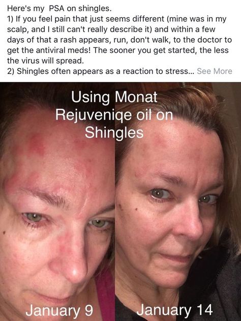 Monat Testimonials, Monat Tips, Monat Rejuveniqe, Monat Haircare, Monat Rejuveniqe Oil, Acne Scar Diy, Monat Before And After, Monat Business, Rejuvenique Oil